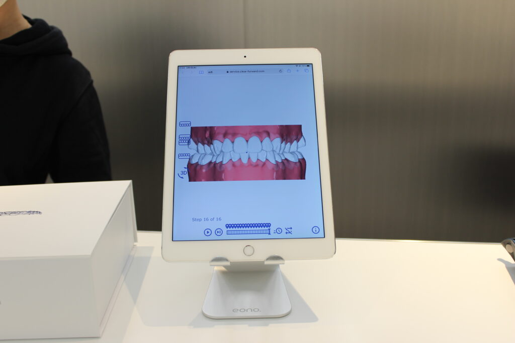 数分口内スキャンして3Dデータが目の前で完成した